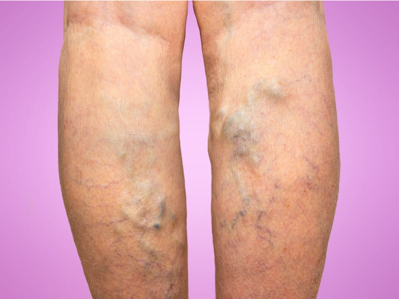 Mans legs showing varicose veins.