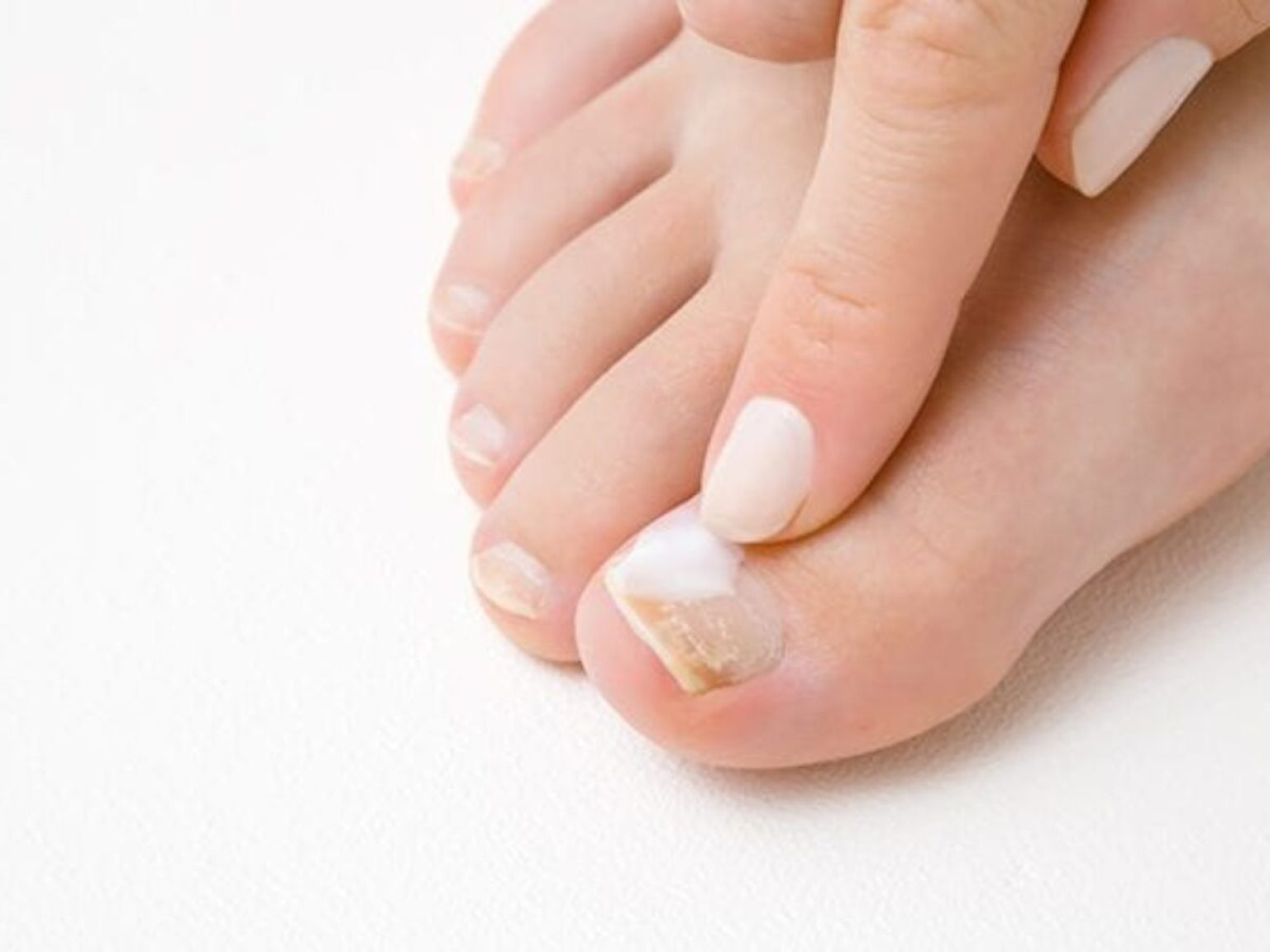 Treating and Eliminating Your Toenail Fungus For Good Hygiene