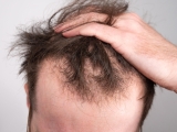 Latest Findings on Hair Loss in Men